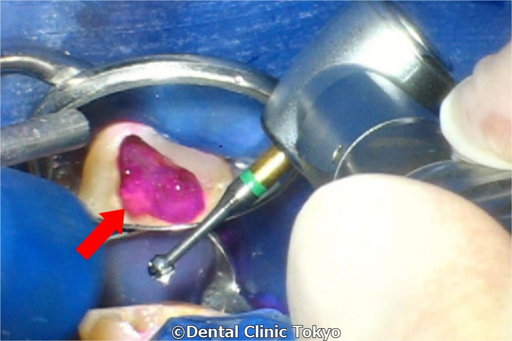 根管内の破折器具を除去して歯を保存した症例