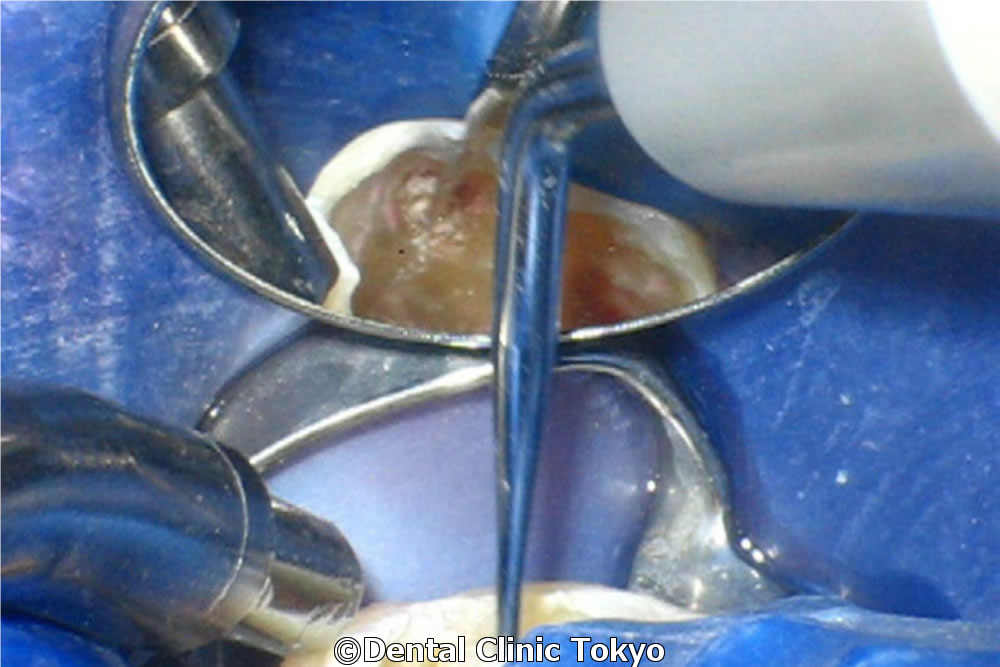 根管内の破折器具を除去して歯を保存した症例