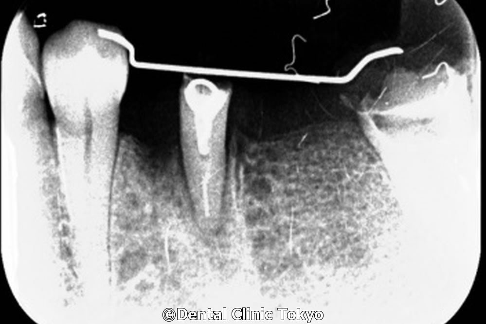 歯の廷出時のレントゲン画像