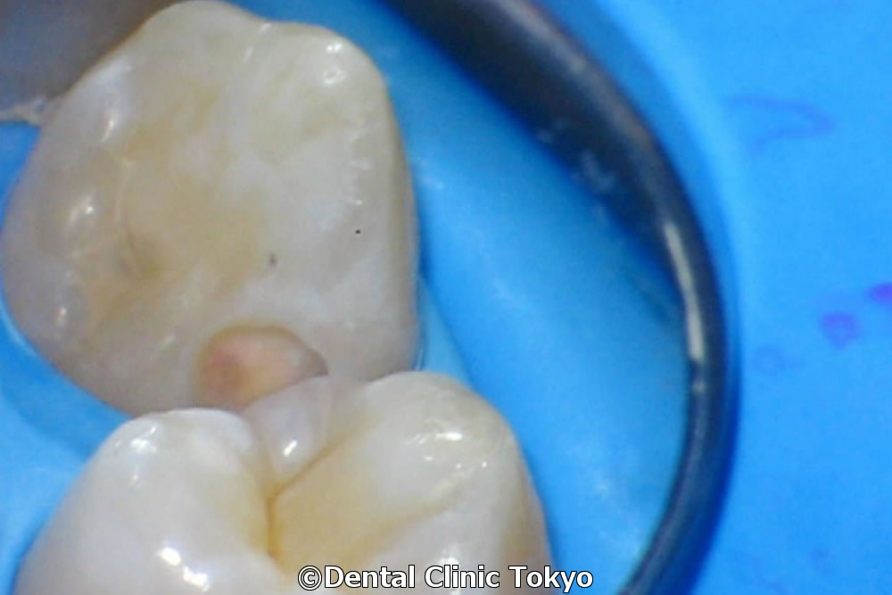 虫歯感染歯質を除去