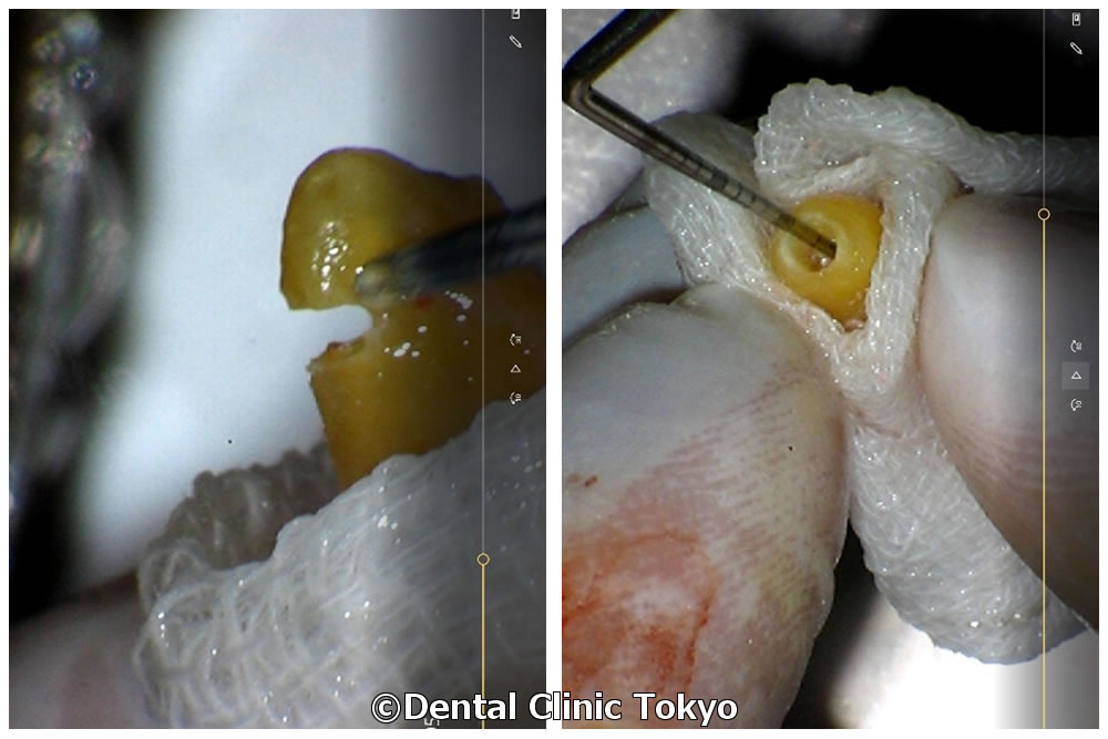 歯根先端の切除・お薬の除去